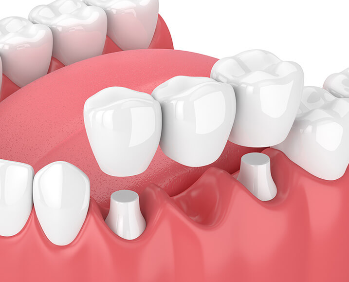 illustration of a dental bridge