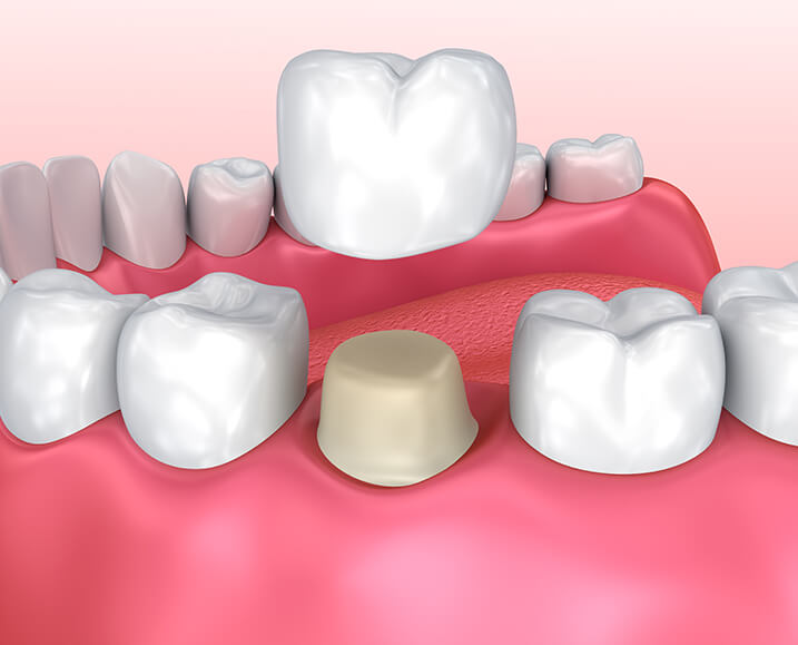 illustration of a dental crown